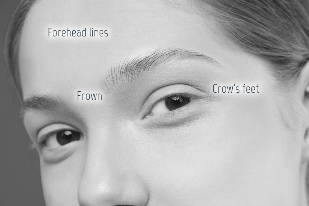 Image of a face showing areas that may be affected by wrinkles and lines