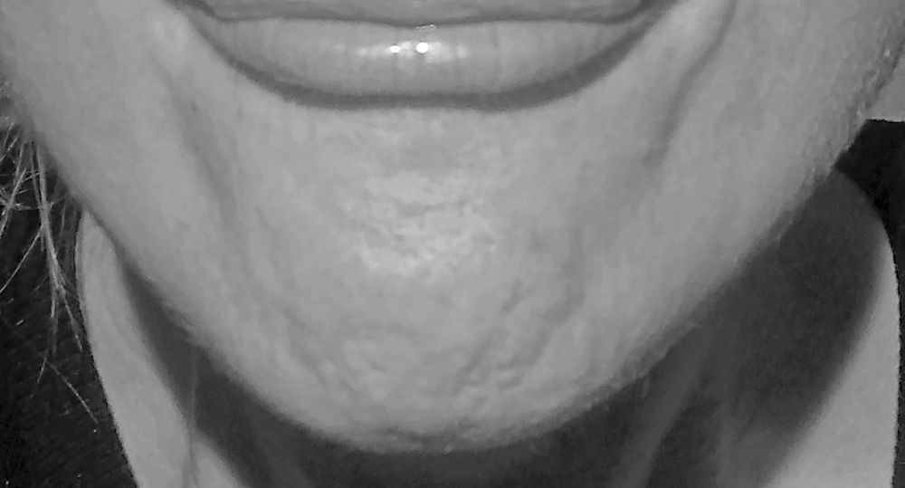Image of a chin, showing dimpling